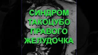 Синдром Такоцубо правого желудочка