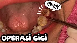 OPERASI GIGI | GERAHAM BUNGSU BAWAH | Dokter Gigi Tri Putra