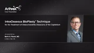 IntraOsseous BioPlasty® Technique for the Treatment of Osteochondritis Dissecans of the Capitellum