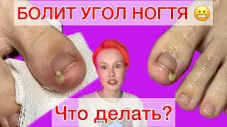 ВРОС НОГОТЬ | ЧТО ДЕЛАТЬ? | БОЛИТ УГОЛОК | ВРОСШИЙ НОГОТЬ НА НОГЕ #алена_лаврентьева #ногти