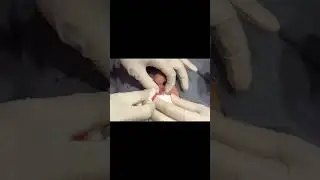 A Lip Cyst Pop