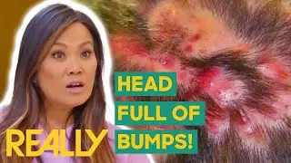 Dr. Lee Helps Dad That’s Been Suffering With Misdiagnosis For 3 Years | Dr. Pimple Popper: Pop Ups