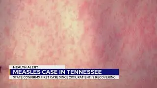 State confirms 1st measles case in TN since 2019