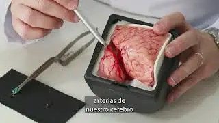 Aneurismas Cerebrales y su tratamiento. Dr. Matias Baldoncini