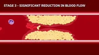 Coronary Artery Disease Animation