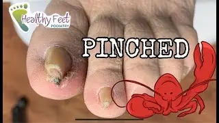 Painful Pinched Toe Nail