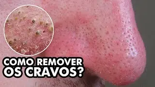 Faça ISSO para remover cravos do seu nariz