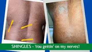 Shingles - Coping with Intense Pain