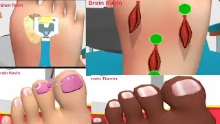 Asmr climber's planter calluses and rot toenails care animation 