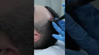 Hair Loss Treatment + RESULTS