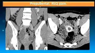 Prepubertal female. RLQ pain