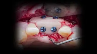 khoury technique for 3D bone reconstruction in the anterior zone