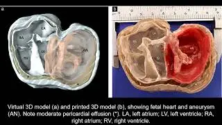 Fetal left ventricular giant aneurysm: three-dimensional virtual and printed models