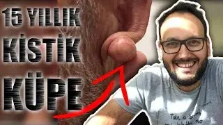 15 YILLIK KÜPESİNİ KESTİK | KULAK MEMESİNDEN KİST ÇIKARMAK