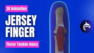 Jersey Finger (Flexor Tendon) Injury and Surgery - 3D animation