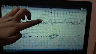 CARDIOTOCOGRAM interpretation in easy way, must do for OSPE