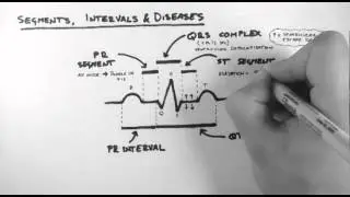 ECG 3 - Segments, Intervals & Diseases