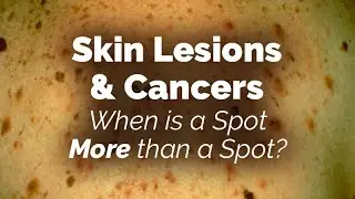 When is a Spot More than a Spot? Skin Lesions and Cancers