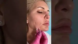 Стимуляция коллагена и воссоздание четкого контура лица с помощью мезонитей☑️