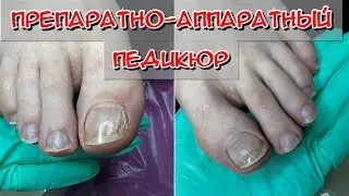 Препаратно-аппаратный педикюр / Средства для педикюра / Фрезы для педикюра