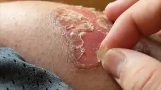 Gross but Satisfying Top 5 Pimples Puss and More! Not for the faint of heart!  The Ick Factor