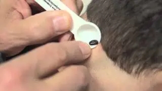 Tick Removal