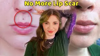 My Lip Piercing Scar Removal | Cost, Before & After