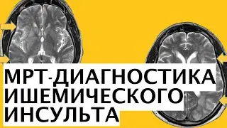 МРТ-диагностика ишемического инсульта | Визуализация инсульта