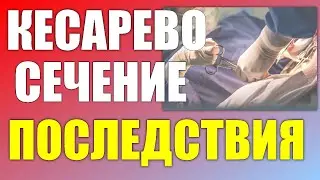 ЭТО НУЖНО ЗНАТЬ ПРО КЕСАРЕВО СЕЧЕНИЕ | 10 вещей которые я хотела бы знать о кесаревом заранее