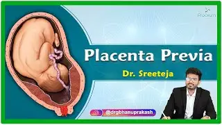 Placenta Previa: Etiology, Pathophysiology, Clinical presentation, Diagnosis and Treatment