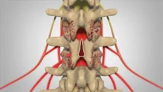 Laminectomy - Patient Education