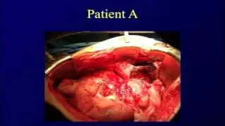 Mesothelioma Foundation Symposium - John Chabot, MD - Peritoneal Mesothelioma