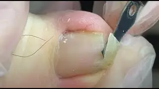 Super thick toenail cleaning