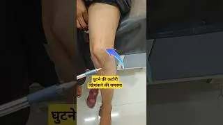 लड़की की घुटने की कटोरी   हमेशा खिसक जाती है | Knee Cap Patellar Dislocation 🔥