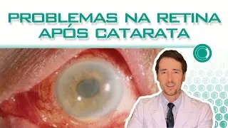 Problemas na retina após catarata - o que fazer?