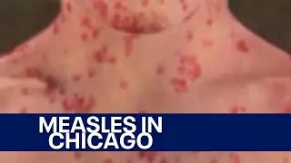 Growing concerns for migrants in Chicago after 2 cases of measles confirmed