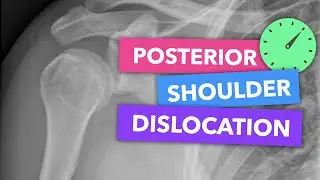 Posterior shoulder dislocation - Radiopaedia Emergency Radiology Course