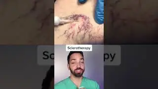 TREATING SPIDER VEINS 