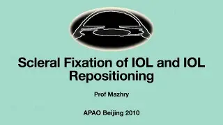 Scleral Fixation of PC IOL- IOL Repositioning Procedure by Dr. Mazhry -APAO-2010-Beijing