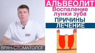 Альвеолит - воспаление лунки зуба после удаления зуба. Причины и лечение