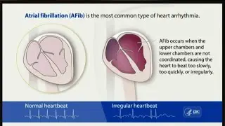 New research sheds light on the best ways to treat Atrial Fibrillation