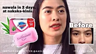 PAANO NAWALA PIMPLES KO? DAHIL SA SAFEGUARD IN 2 DAYS!!! 18PHP LANG!