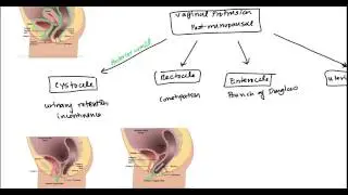 Uterine Prolapse and Vaginal Prolapse for USMLE