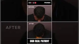 Hair Transformation: PRP Treatment Results After 3 Sessions! | Testimonial | HairMD, Pune