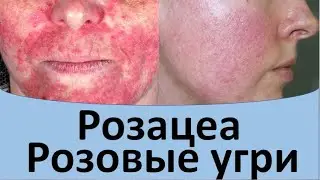 Розацеа. Розовые угри.