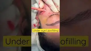 Under eye Lipofilling | Lipoinjection | Fat transfer to face | Fat grafting | Under eye filler