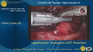 Laparoscopic Transgastric GIST Resection