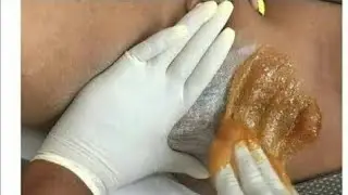 BRAZILIAN BIKINI SUGARWAXING LIKE A PRO