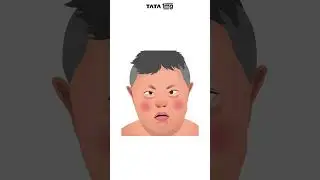 What is Down Syndrome? 