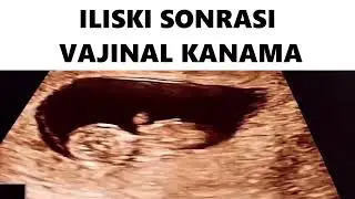 ILISKI SONRASI  VAJINAL KANAMA #ultrasound #pregnancytest #baby #pregnancyscan